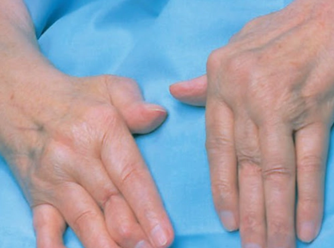 类风湿关节炎自愈