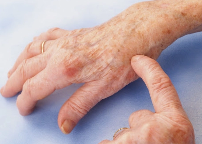 类风湿关节炎怎么治疗